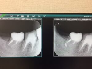 外科的歯内療法